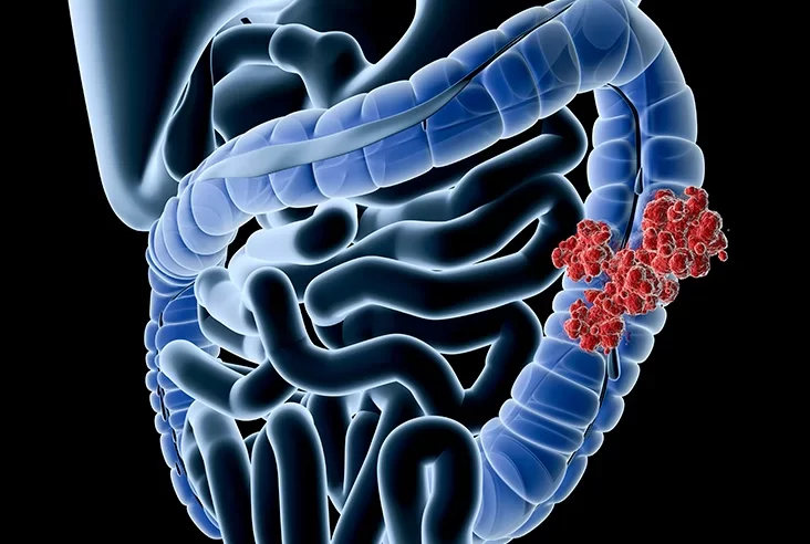 دراسة توضح اختلاف أعراض سرطان القولون لدى الشباب