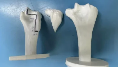 إنجاز طبي سعودي بزراعة عظم ومفصل مرفق بالخبر