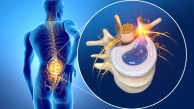 الانزلاق الغضروفي.. أعراضه وطرق علاجه والوقاية منه