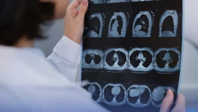 تطوير قطرة أنفية لمكافحة سرطان الدماغ