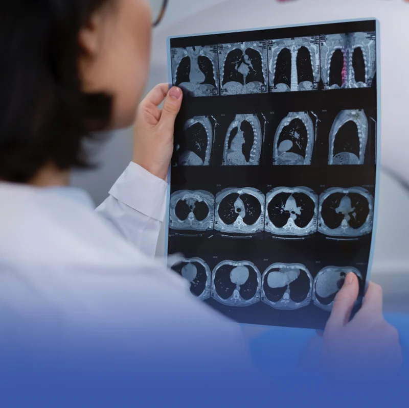 تطوير قطرة أنفية لمكافحة سرطان الدماغ تطوير قطرة أنفية لمكافحة سرطان الدماغ