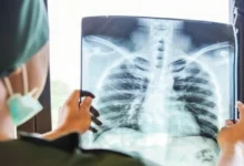 السُعال الديكي.. أعراضه وعلاجه والفئات الأكثر عُرضة له