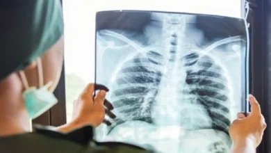 السُعال الديكي.. أعراضه وعلاجه والفئات الأكثر عُرضة له